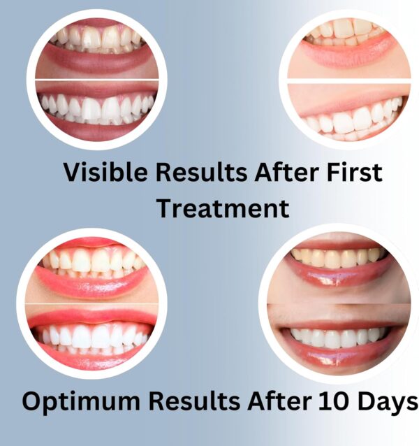 teeth whitening gel refills before after results